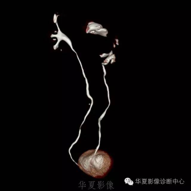 【病例】肾盂旁囊肿1例——CTU让你更清楚的认识这个疾病 【病例】肾盂旁囊肿1例——CTU让你更清楚的认识这个疾病