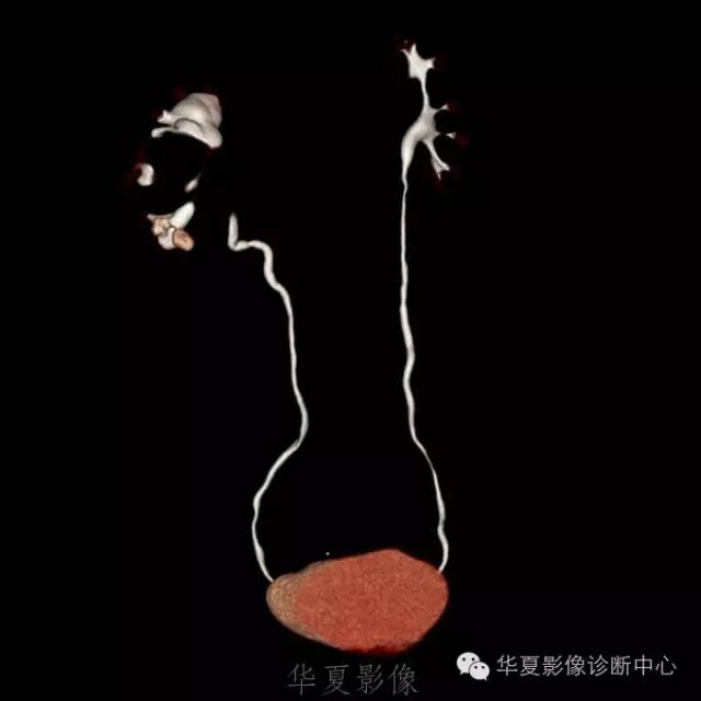 【病例】肾盂旁囊肿1例——CTU让你更清楚的认识这个疾病 【病例】肾盂旁囊肿1例——CTU让你更清楚的认识这个疾病