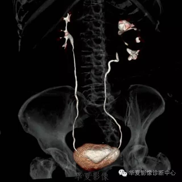 【病例】肾盂旁囊肿1例——CTU让你更清楚的认识这个疾病 【病例】肾盂旁囊肿1例——CTU让你更清楚的认识这个疾病