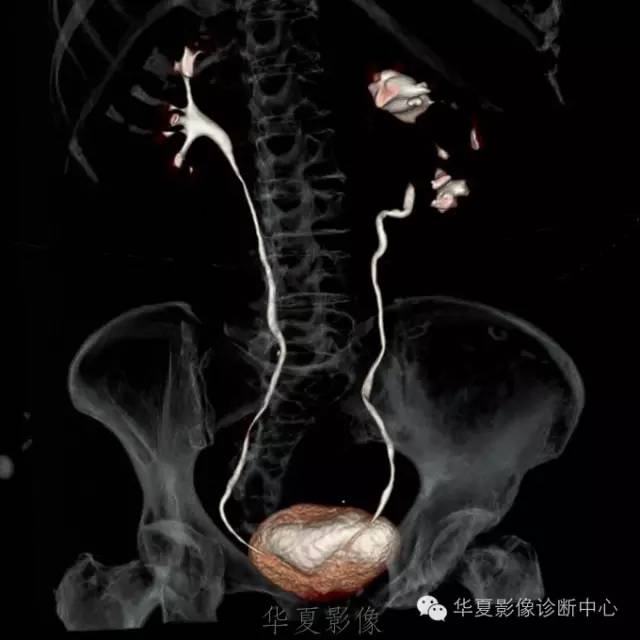 【病例】肾盂旁囊肿1例——CTU让你更清楚的认识这个疾病 【病例】肾盂旁囊肿1例——CTU让你更清楚的认识这个疾病
