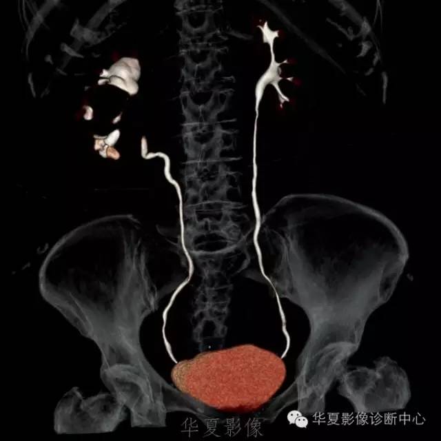 【病例】肾盂旁囊肿1例——CTU让你更清楚的认识这个疾病 【病例】肾盂旁囊肿1例——CTU让你更清楚的认识这个疾病