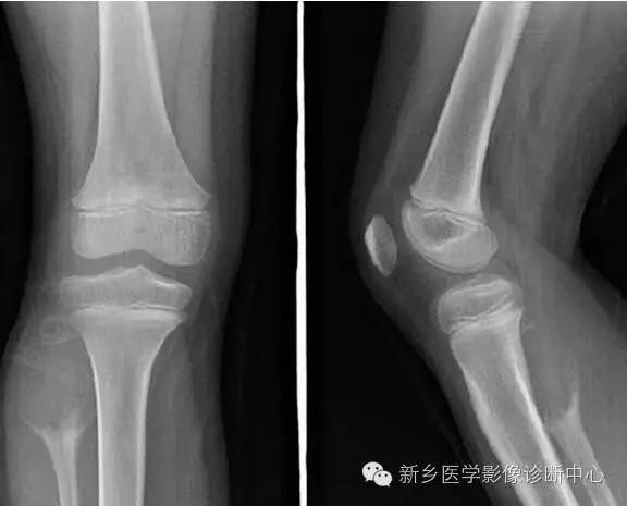 10种发生在长骨的偏心性膨胀性病变 10种发生在长骨的偏心性膨胀性病变