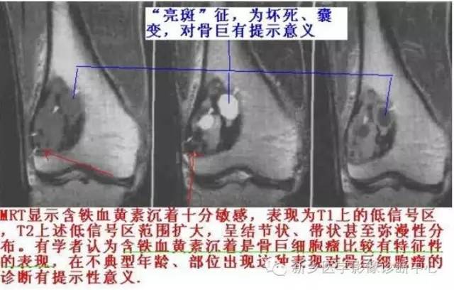 10种发生在长骨的偏心性膨胀性病变 10种发生在长骨的偏心性膨胀性病变