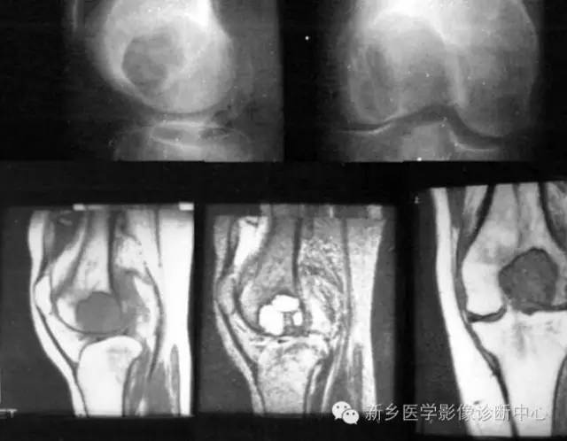 10种发生在长骨的偏心性膨胀性病变 10种发生在长骨的偏心性膨胀性病变