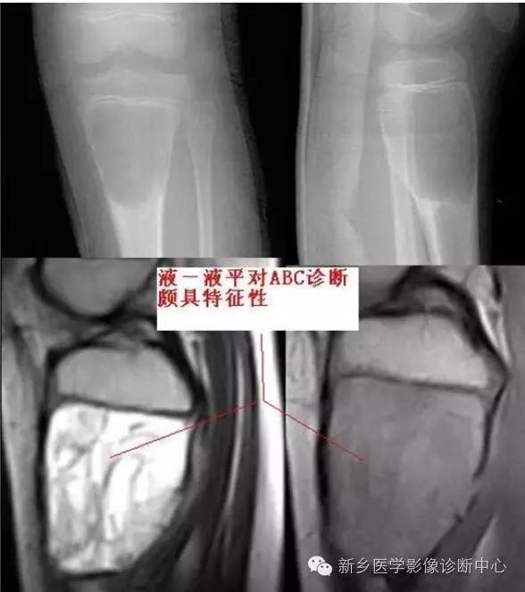 10种发生在长骨的偏心性膨胀性病变 10种发生在长骨的偏心性膨胀性病变