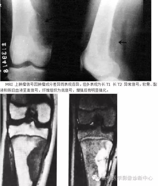 10种发生在长骨的偏心性膨胀性病变 10种发生在长骨的偏心性膨胀性病变