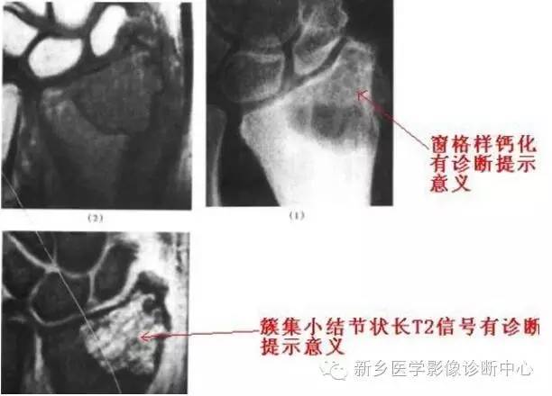 10种发生在长骨的偏心性膨胀性病变 10种发生在长骨的偏心性膨胀性病变