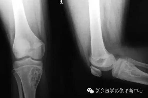 10种发生在长骨的偏心性膨胀性病变 10种发生在长骨的偏心性膨胀性病变