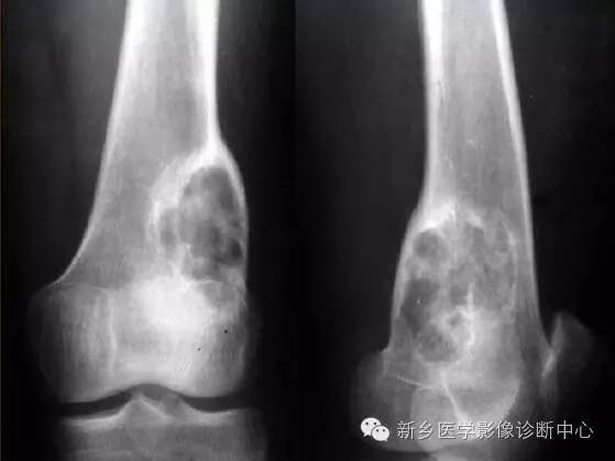 10种发生在长骨的偏心性膨胀性病变 10种发生在长骨的偏心性膨胀性病变