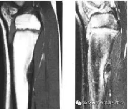 10种发生在长骨的偏心性膨胀性病变 10种发生在长骨的偏心性膨胀性病变