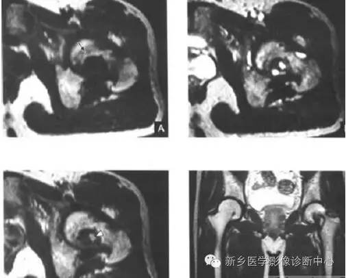 10种发生在长骨的偏心性膨胀性病变 10种发生在长骨的偏心性膨胀性病变