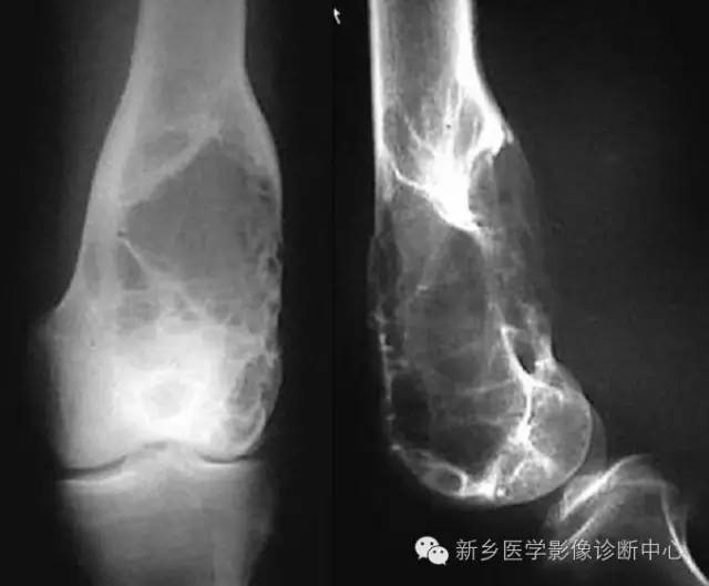 10种发生在长骨的偏心性膨胀性病变 10种发生在长骨的偏心性膨胀性病变