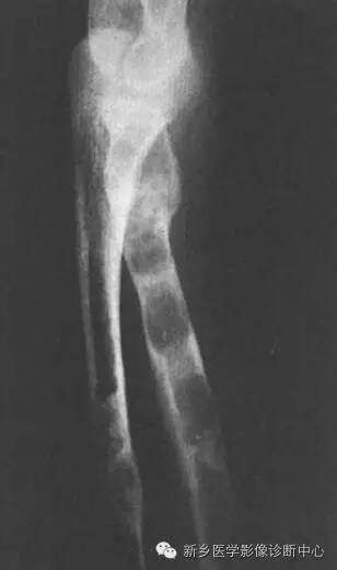 10种发生在长骨的偏心性膨胀性病变 10种发生在长骨的偏心性膨胀性病变