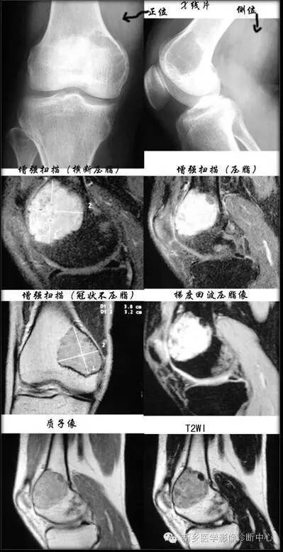 10种发生在长骨的偏心性膨胀性病变 10种发生在长骨的偏心性膨胀性病变