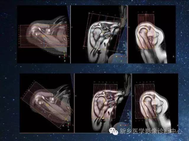 【PPT】骨关节MR扫描及注意事项
