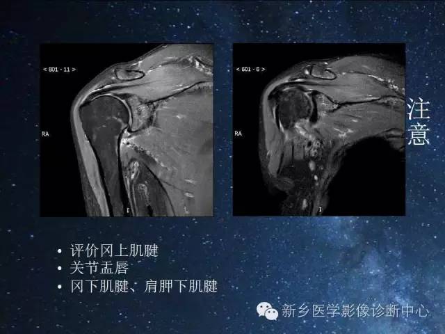【PPT】骨关节MR扫描及注意事项