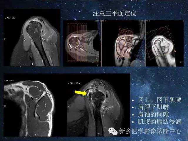 【PPT】骨关节MR扫描及注意事项