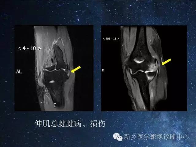 【PPT】骨关节MR扫描及注意事项