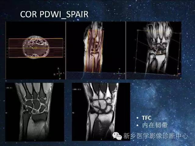 【PPT】骨关节MR扫描及注意事项