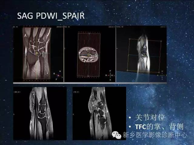 【PPT】骨关节MR扫描及注意事项