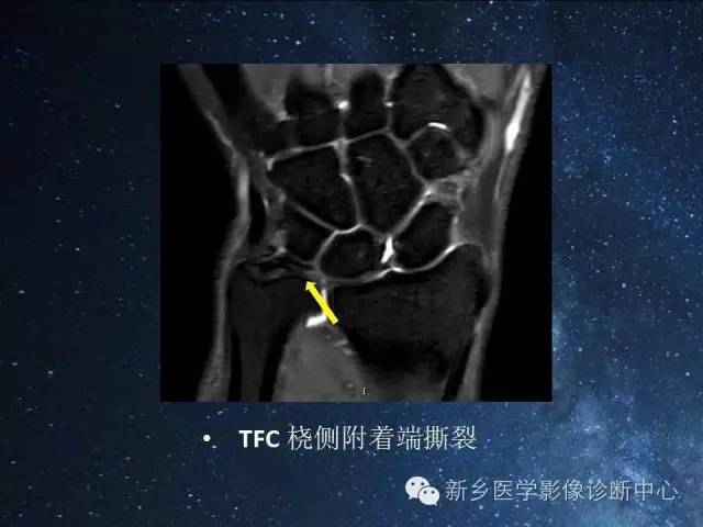 【PPT】骨关节MR扫描及注意事项