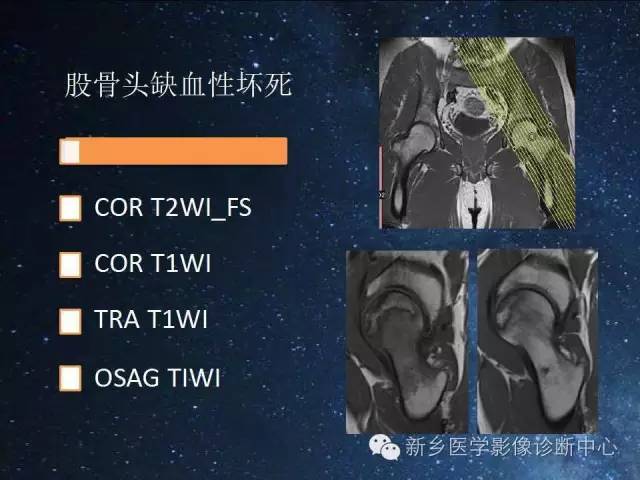 【PPT】骨关节MR扫描及注意事项