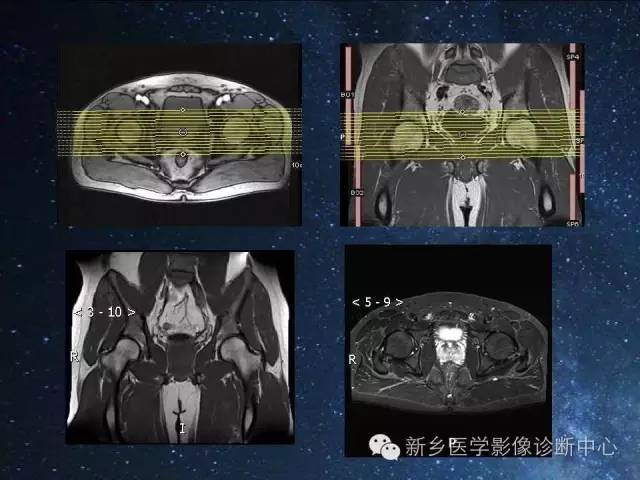 【PPT】骨关节MR扫描及注意事项