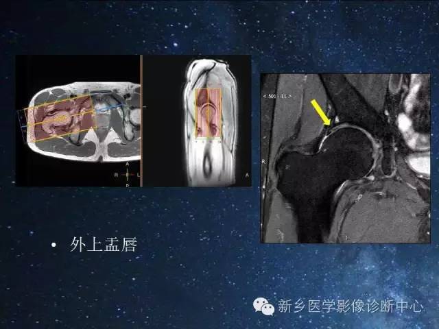 【PPT】骨关节MR扫描及注意事项
