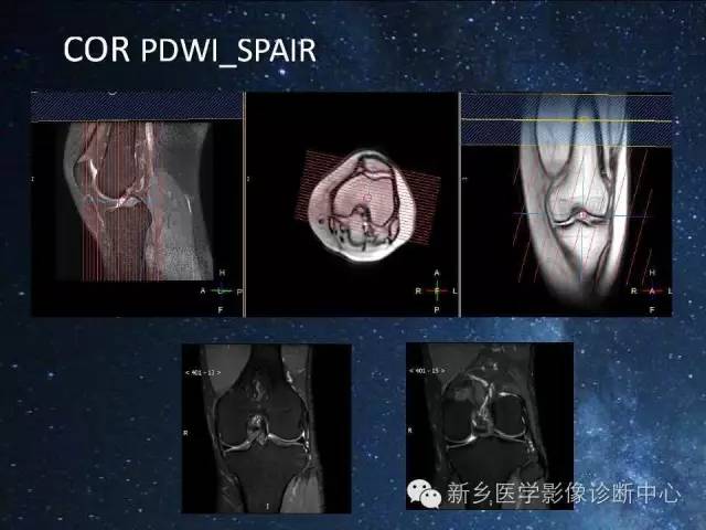 【PPT】骨关节MR扫描及注意事项