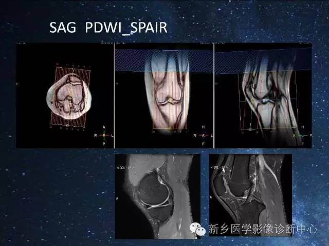 【PPT】骨关节MR扫描及注意事项