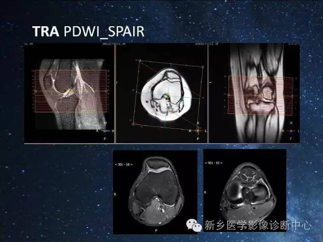 【PPT】骨关节MR扫描及注意事项