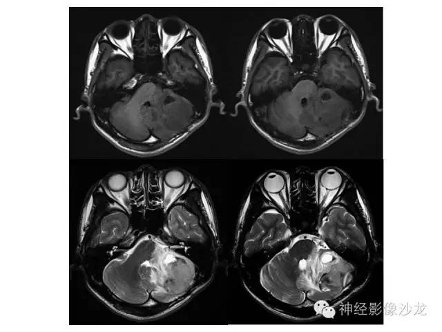 【病例】恶性脑膜瘤一例MR影像表现