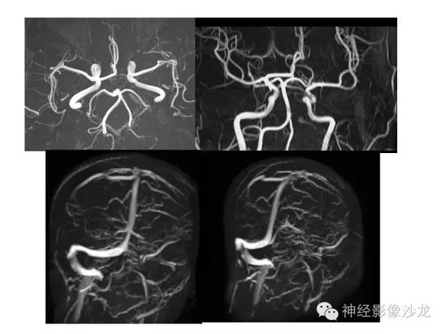 【病例】恶性脑膜瘤一例MR影像表现
