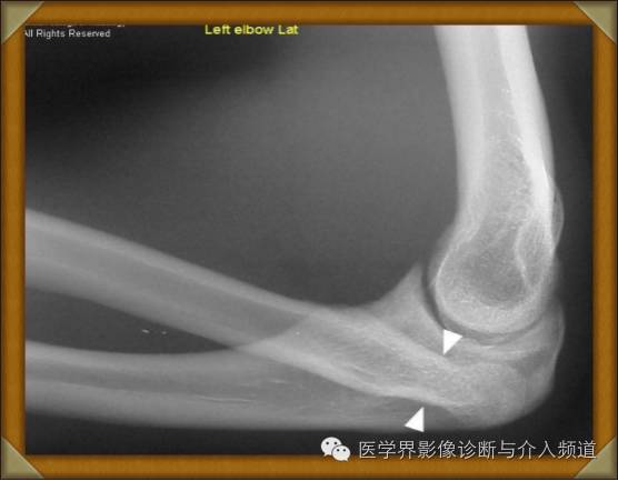 【病例】先天性桡骨头脱位1例 【病例】先天性桡骨头脱位1例
