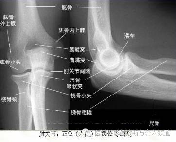 【病例】先天性桡骨头脱位1例 【病例】先天性桡骨头脱位1例