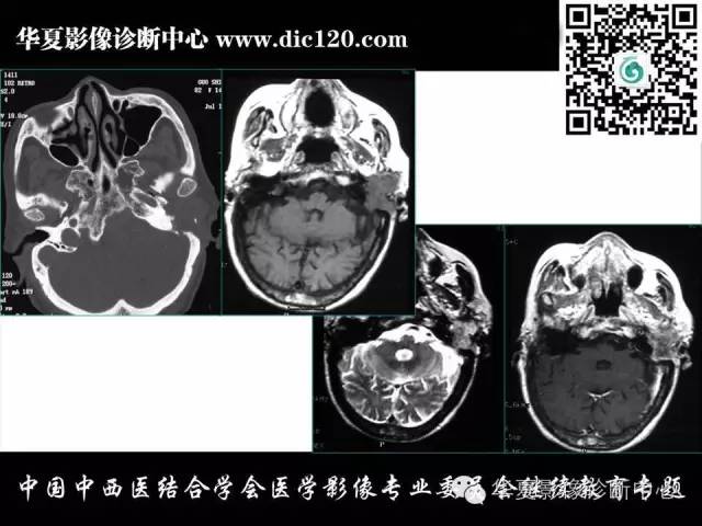 【PPT】耳部疾病的影像诊断和鉴别