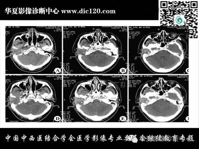 【PPT】耳部疾病的影像诊断和鉴别
