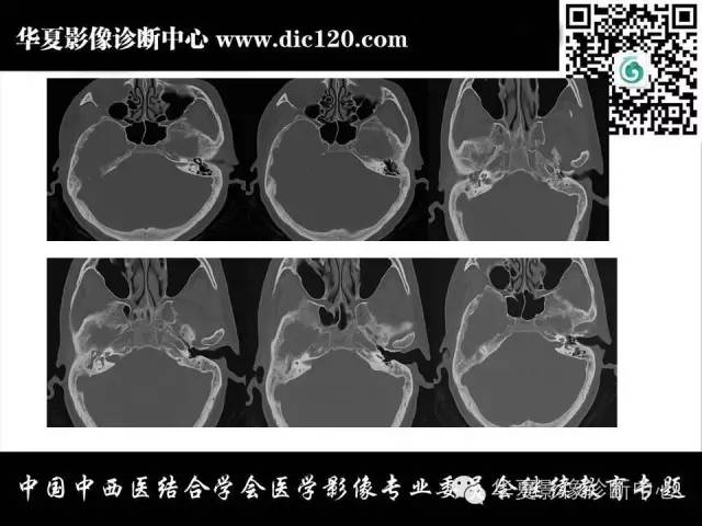 【PPT】耳部疾病的影像诊断和鉴别
