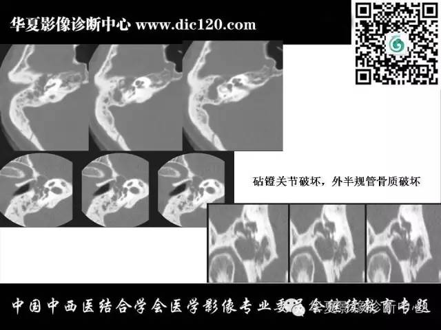 【PPT】耳部疾病的影像诊断和鉴别