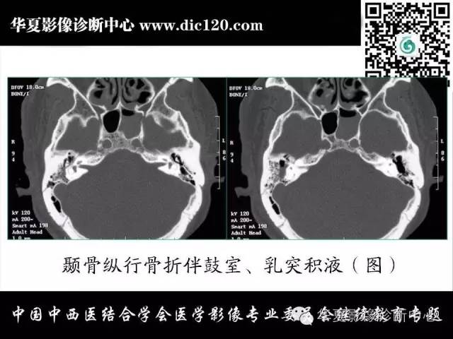 【PPT】耳部疾病的影像诊断和鉴别