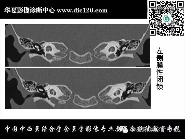【PPT】耳部疾病的影像诊断和鉴别