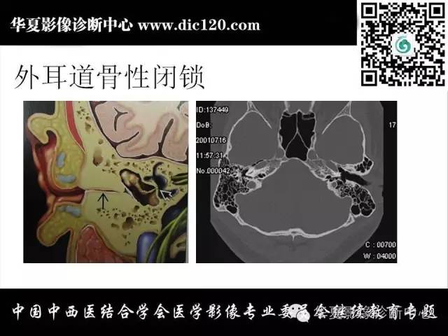 【PPT】耳部疾病的影像诊断和鉴别