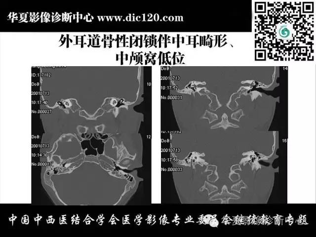 【PPT】耳部疾病的影像诊断和鉴别