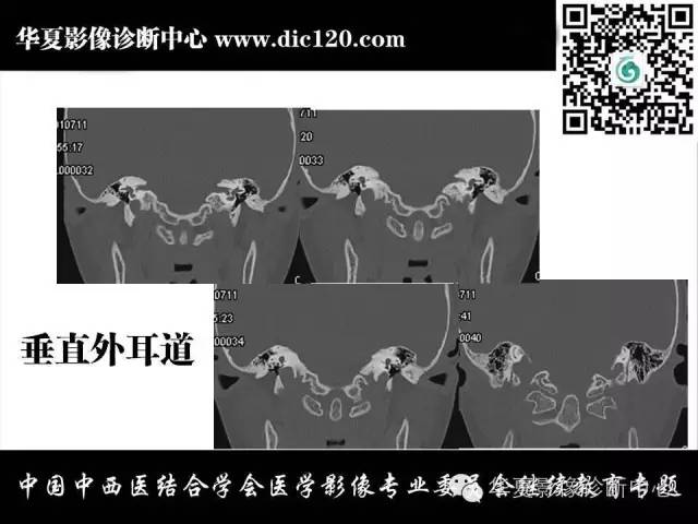 【PPT】耳部疾病的影像诊断和鉴别