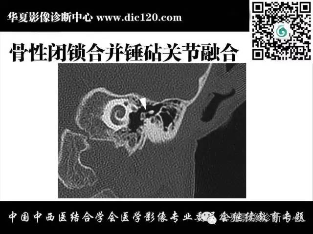 【PPT】耳部疾病的影像诊断和鉴别