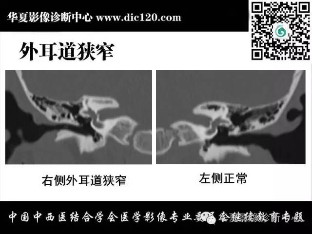 【PPT】耳部疾病的影像诊断和鉴别