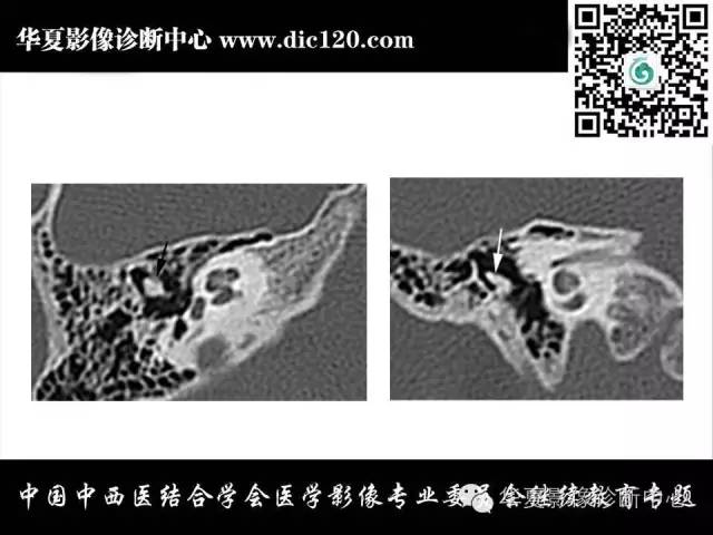 【PPT】耳部疾病的影像诊断和鉴别