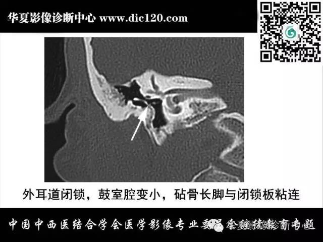 【PPT】耳部疾病的影像诊断和鉴别