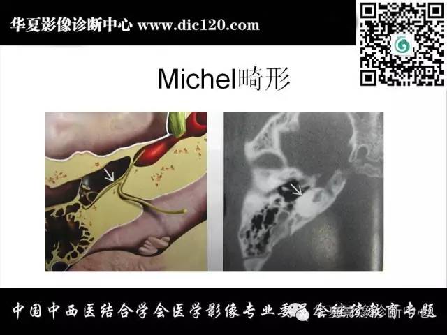 【PPT】耳部疾病的影像诊断和鉴别