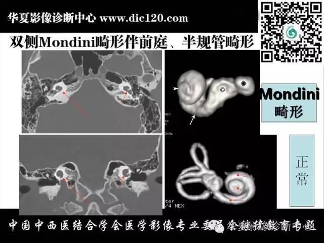 【PPT】耳部疾病的影像诊断和鉴别